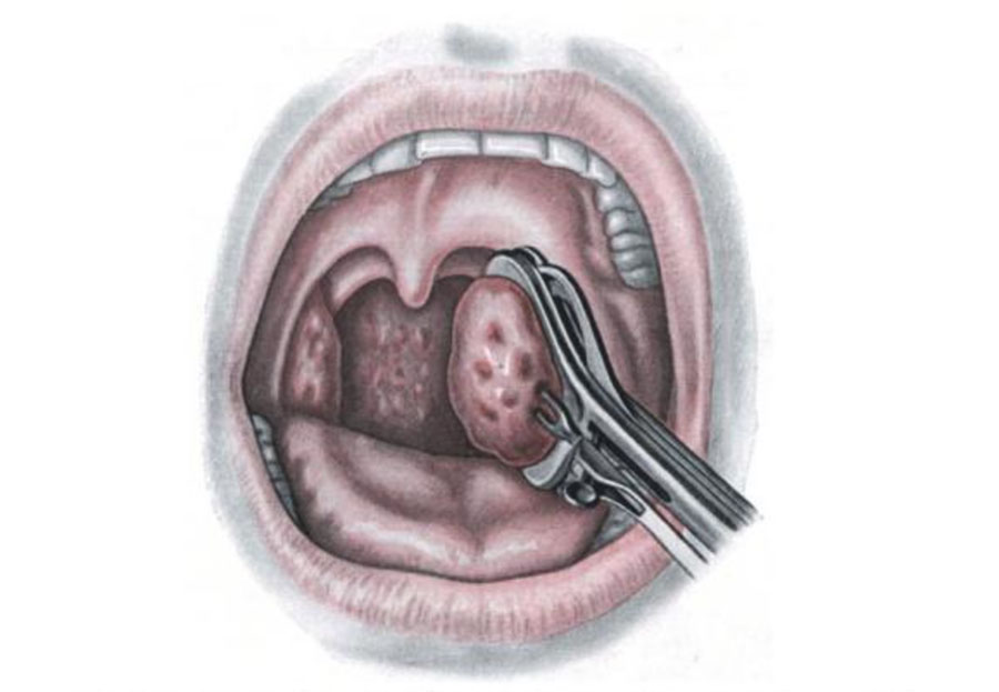 Il tonsillotomo a ghigliottina di Fahnestock